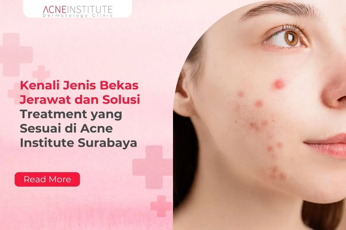 Kenali Jenis Bekas Jerawat dan Solusi Treatment yang Sesuai di Acne Institute Surabaya