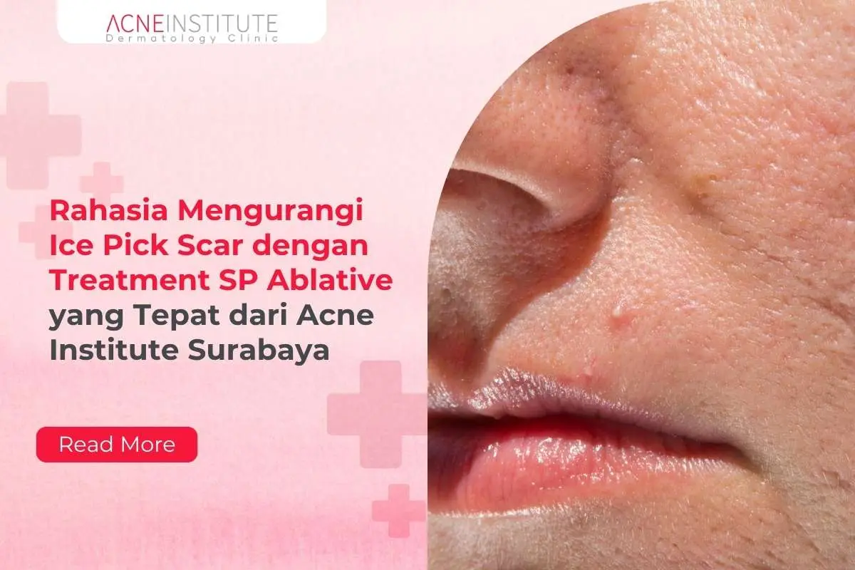 Rahasia Mengurangi Ice Pick Scar dengan Treatment SP Ablative yang Tepat dari Acne Institute Surabaya