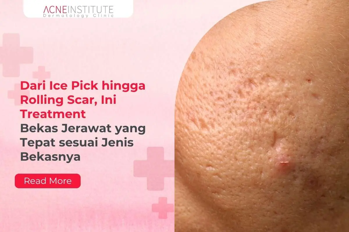 Dari Ice Pick hingga Rolling Scar, Ini Treatment Bekas Jerawat yang Tepat sesuai Jenis Bekasnya