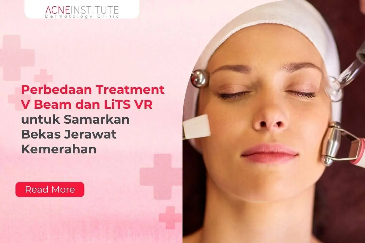 Perbedaan Treatment V Beam dan LiTS VR untuk Samarkan Bekas Jerawat Kemerahan