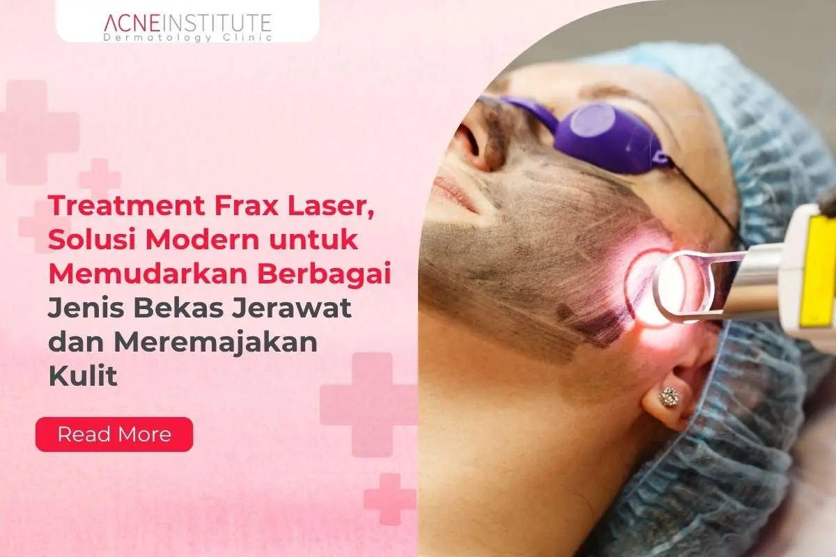 Treatment Frax Laser, Solusi Modern untuk Memudarkan Berbagai Jenis Bekas Jerawat dan Meremajakan Kulit