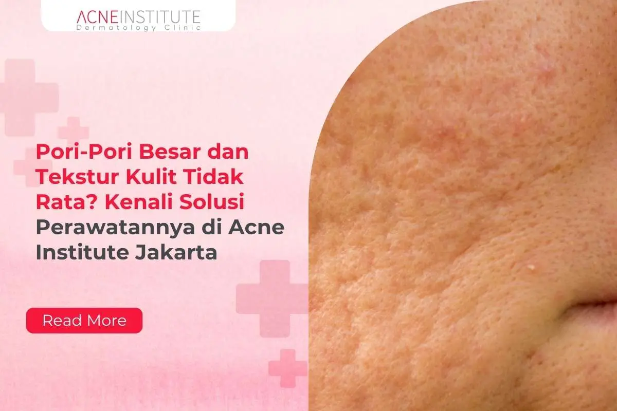 Pori-Pori Besar dan Tekstur Kulit Tidak Rata? Kenali Solusi Perawatannya di Acne Institute Jakarta