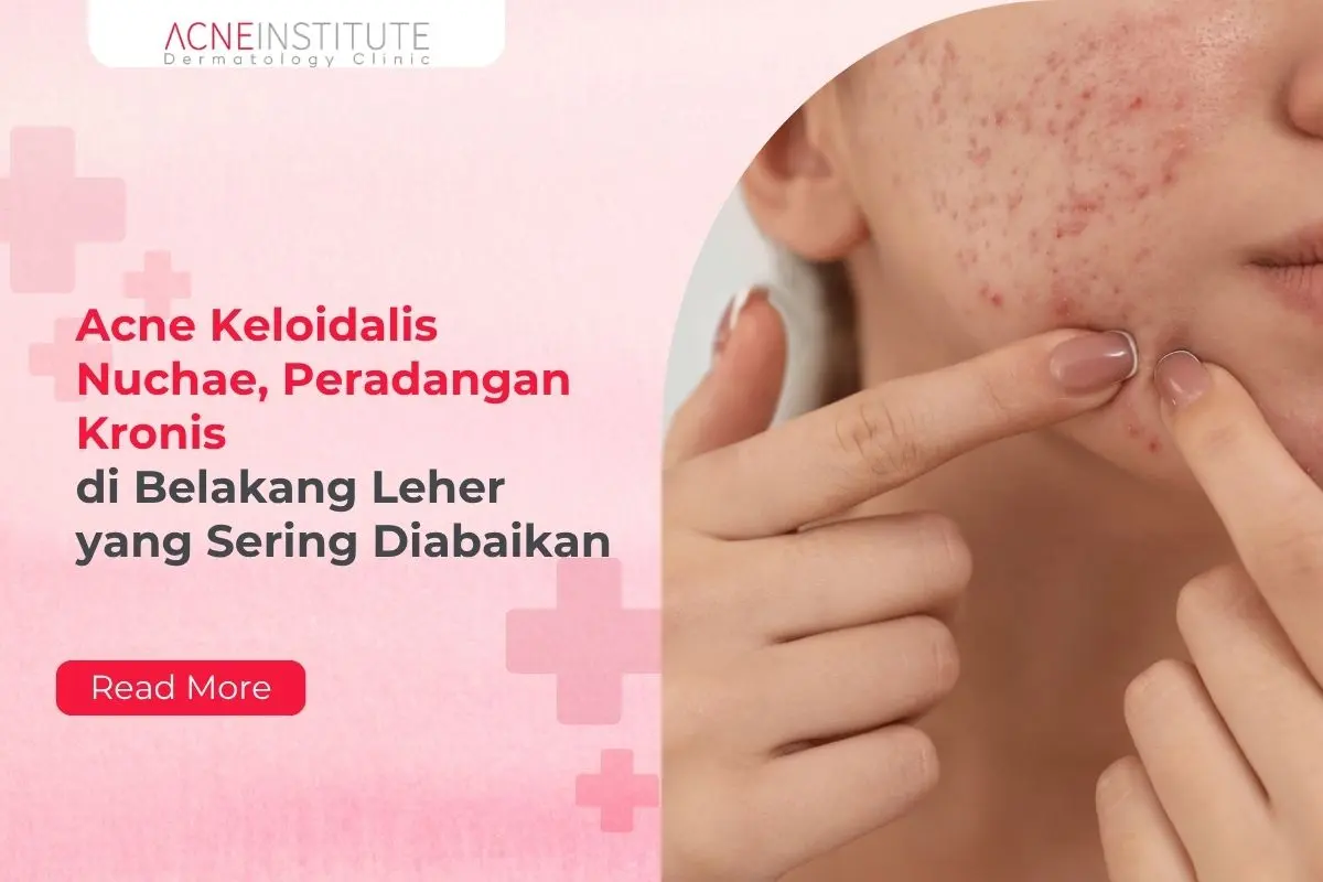 Acne Keloidalis Nuchae, Peradangan Kronis di Belakang Leher yang Sering Diabaikan