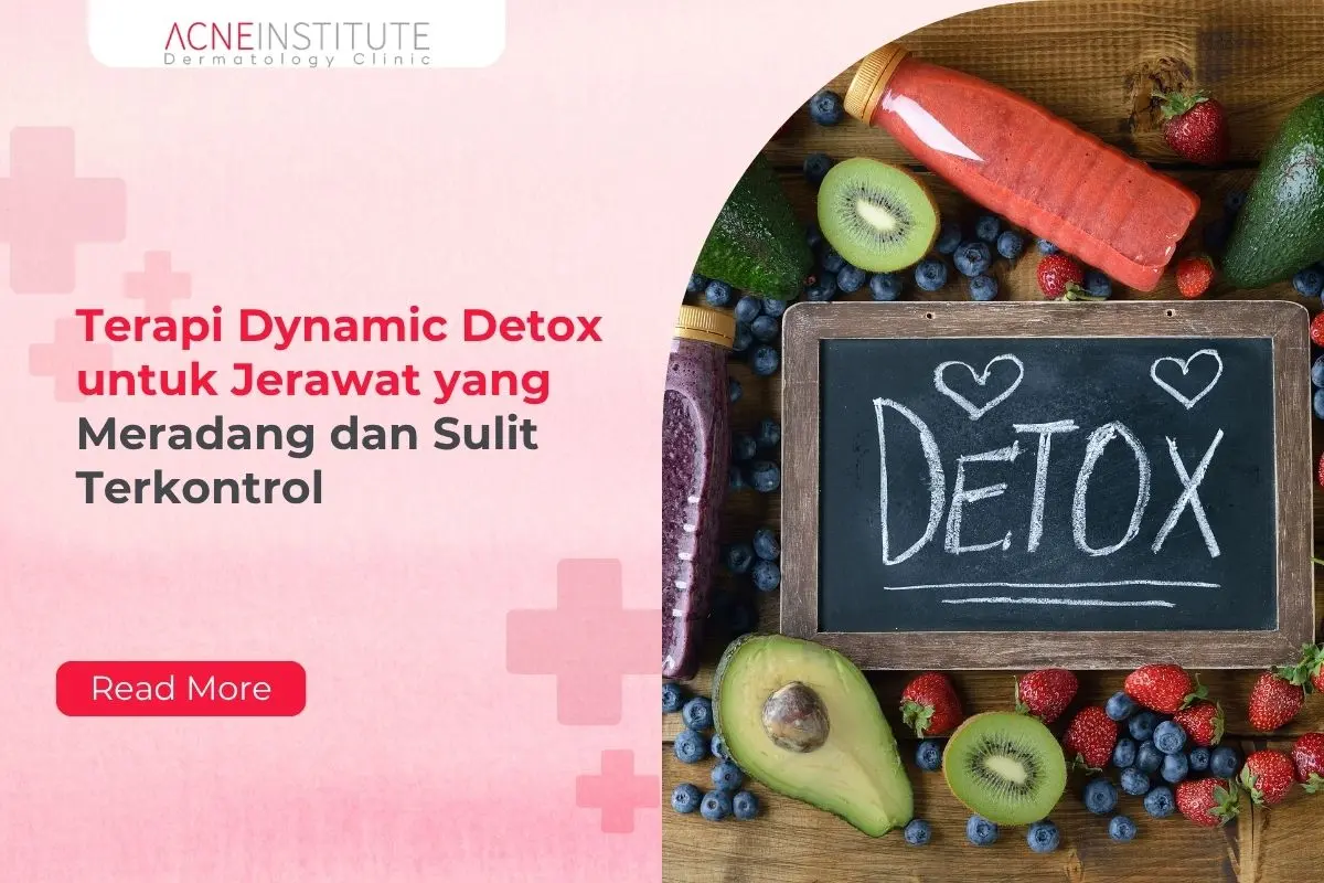 Terapi Dynamic Detox untuk Jerawat yang Meradang dan Sulit Terkontrol