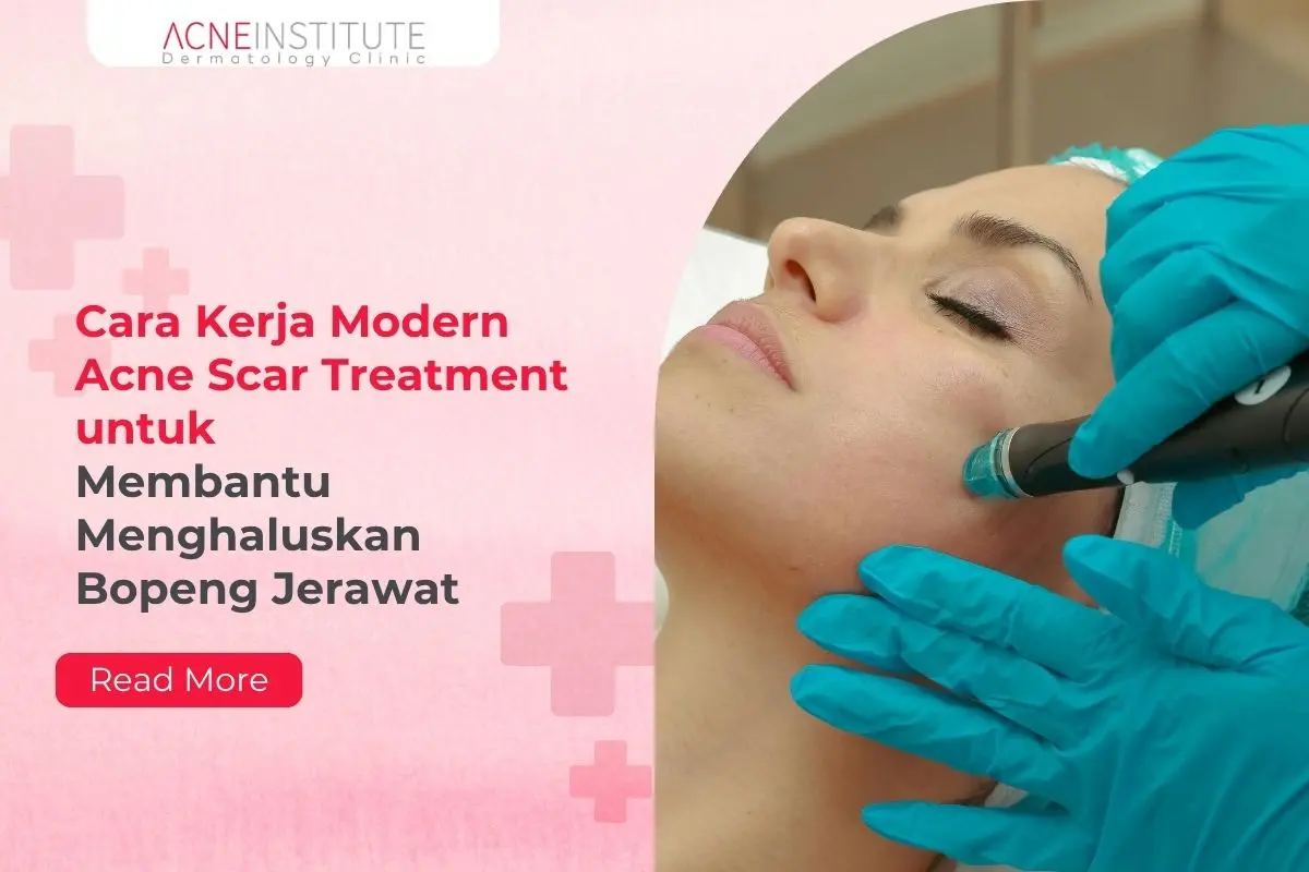 Cara Kerja Modern Acne Scar Treatment untuk Membantu Menghaluskan Bopeng Jerawat