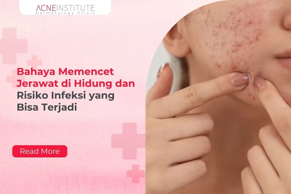Bahaya Memencet Jerawat di Hidung dan Risiko Infeksi yang Bisa Terjadi