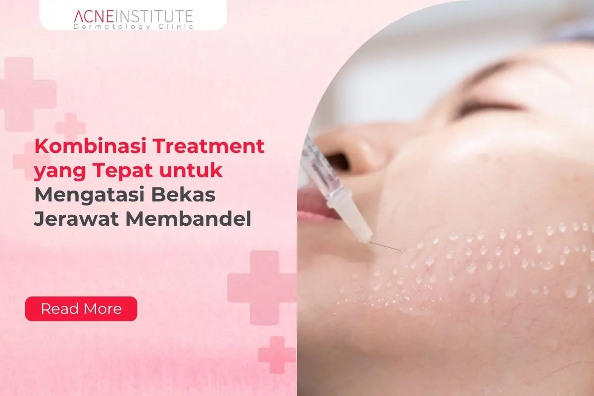 Kombinasi Treatment yang Tepat untuk Mengatasi Bekas Jerawat Membandel