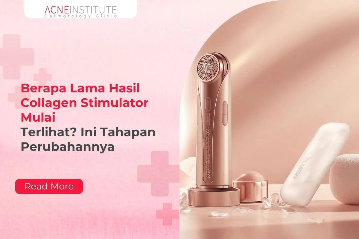Berapa Lama Hasil Collagen Stimulator Mulai Terlihat? Ini Tahapan Perubahannya