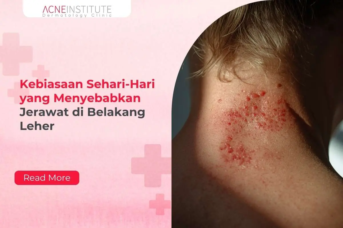 Kebiasaan Sehari-Hari yang Menyebabkan Jerawat di Belakang Leher