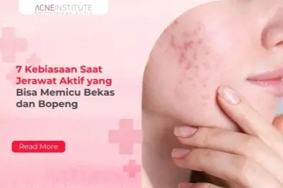 7 Kebiasaan Saat Jerawat Aktif yang Bisa Memicu Bekas dan Bopeng