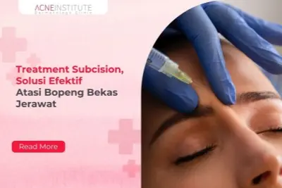 Treatment Subcision, Solusi Efektif Atasi Bopeng Bekas Jerawat