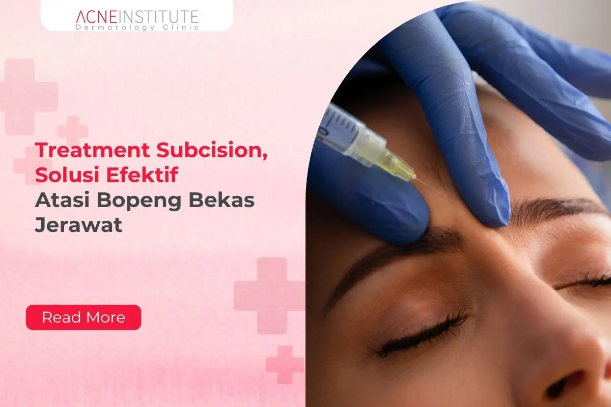 Treatment Subcision, Solusi Efektif Atasi Bopeng Bekas Jerawat