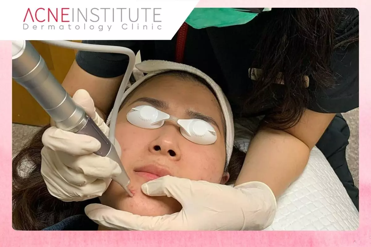 Perawatan Aman dan Efektif di Acne Institute Clinic