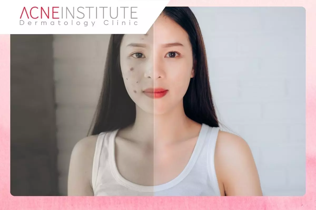 Mengapa Makeup Bisa Memperburuk Jerawat?