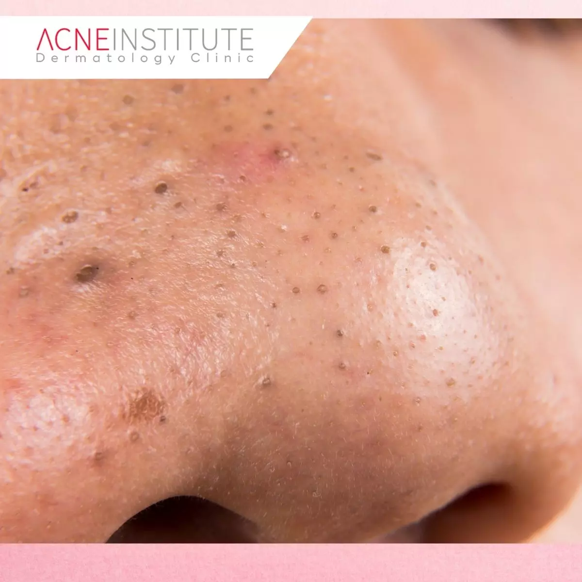 Komedo (Blackheads & Whiteheads)