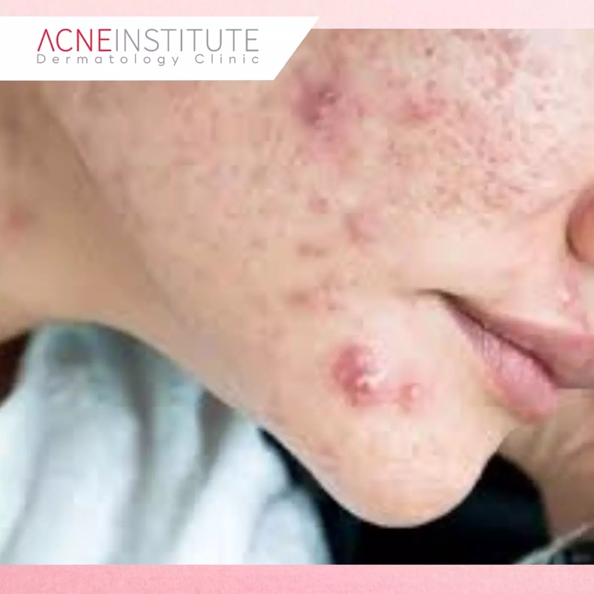 Jerawat Kistik (Cystic Acne)