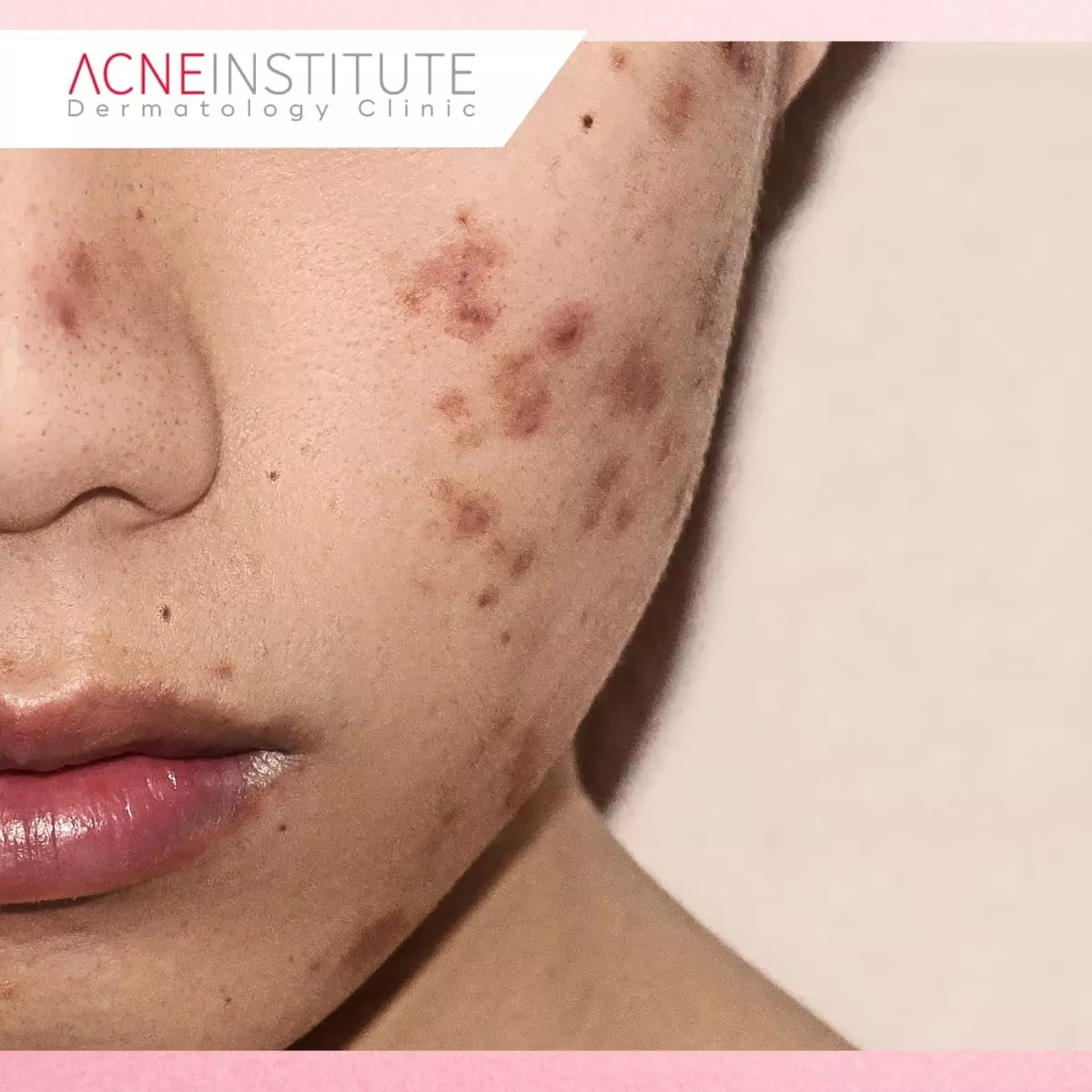 Mengenal Apa Itu Acne Scar