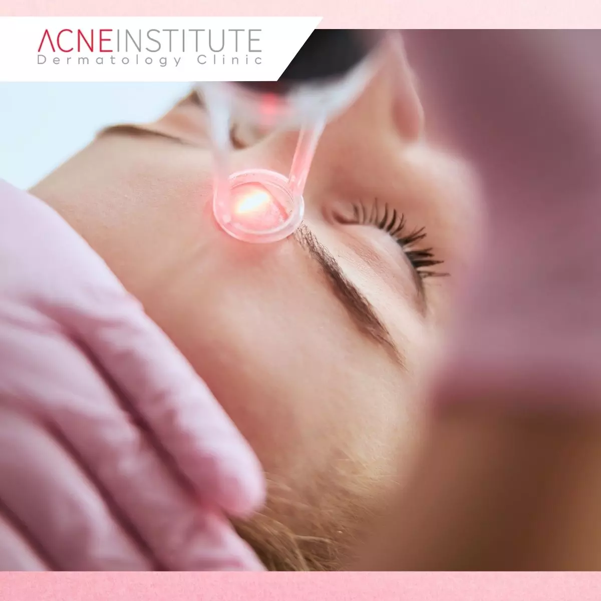 Berapa Lama Hasil Treatment Bopeng Bisa Terlihat?