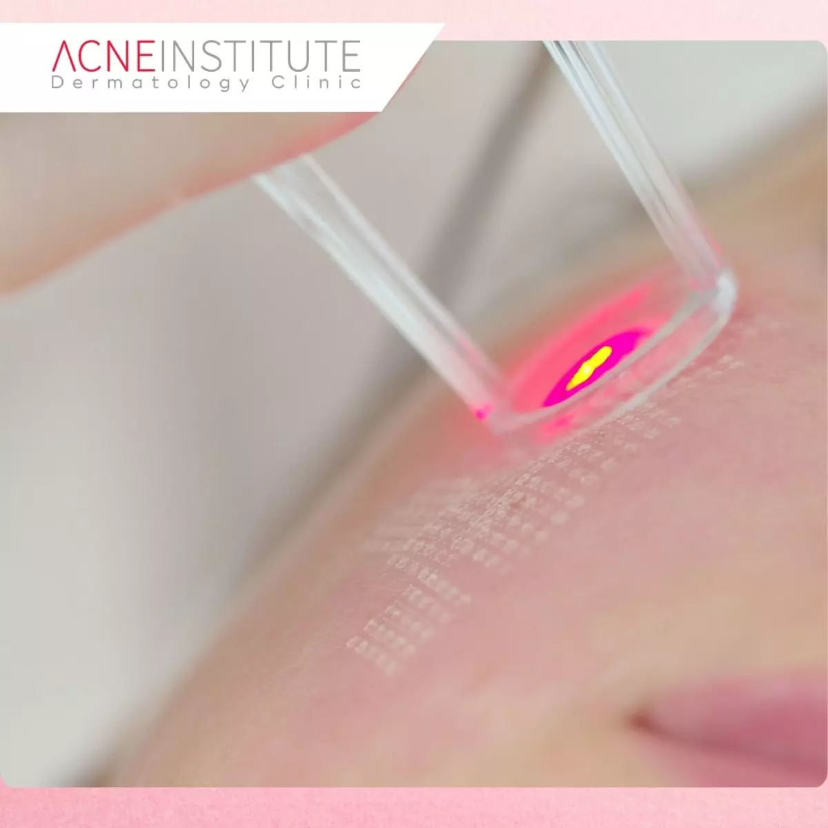 Perawatan Laser Wajah di Acne Institute Surabaya