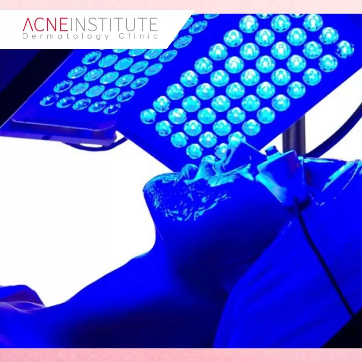 Prosedur Terapi Red Blue di Acne Institute