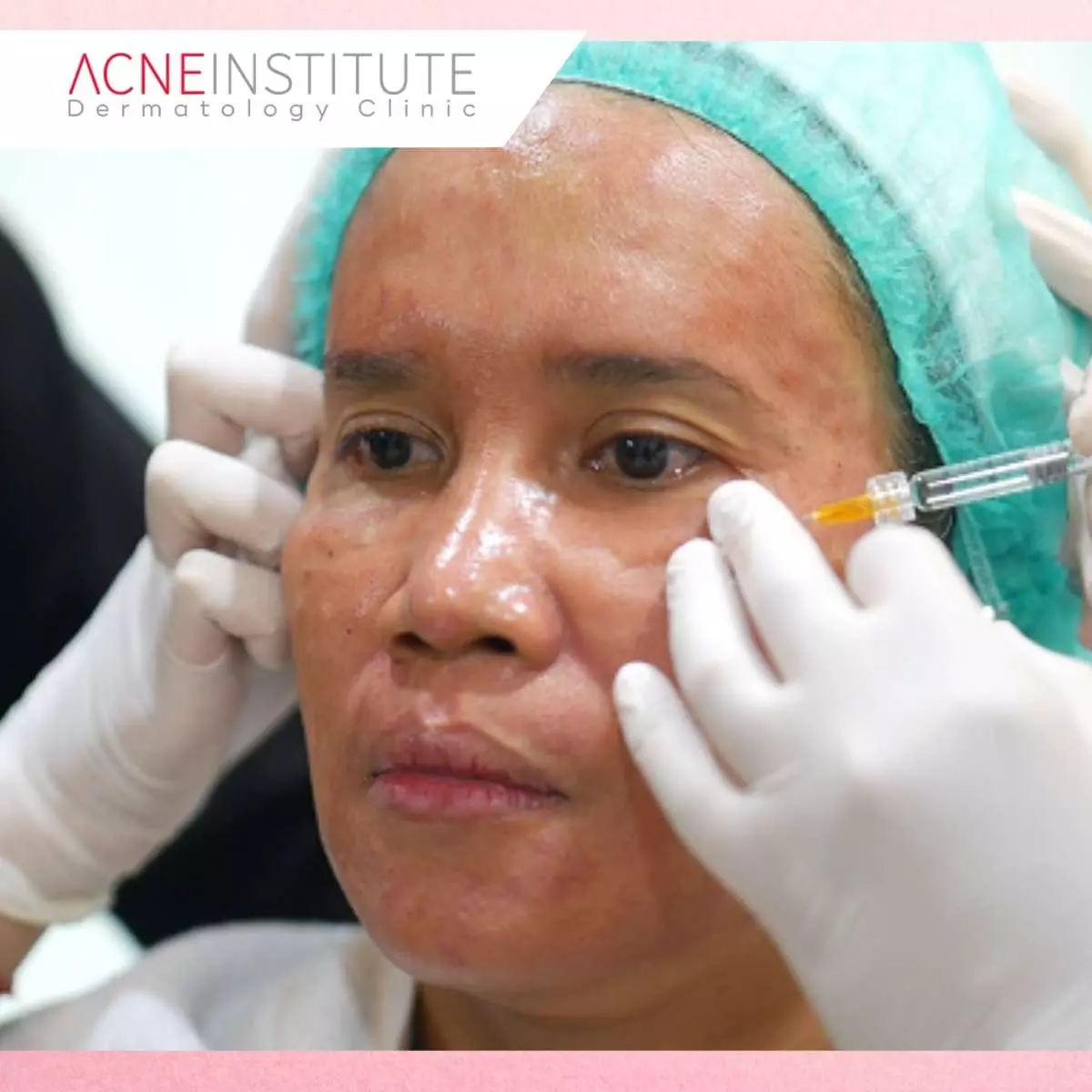 Apa itu Collagen Stimulator