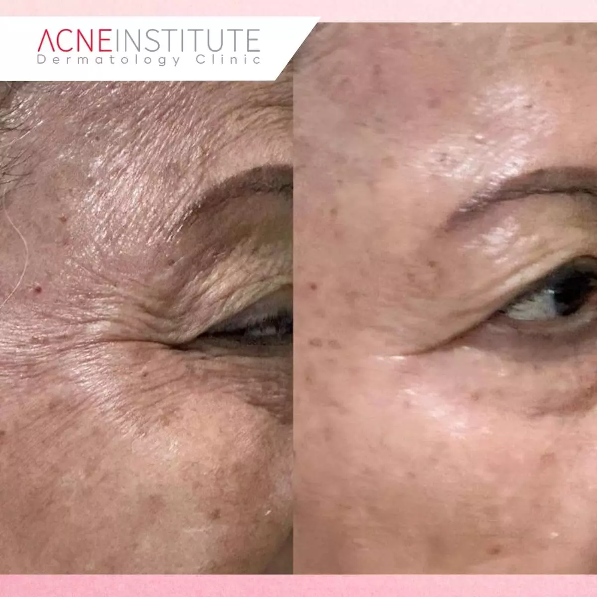Proses dan Cara Kerja Collagen Stimulator Perawatan Anti Aging untuk Wajah
