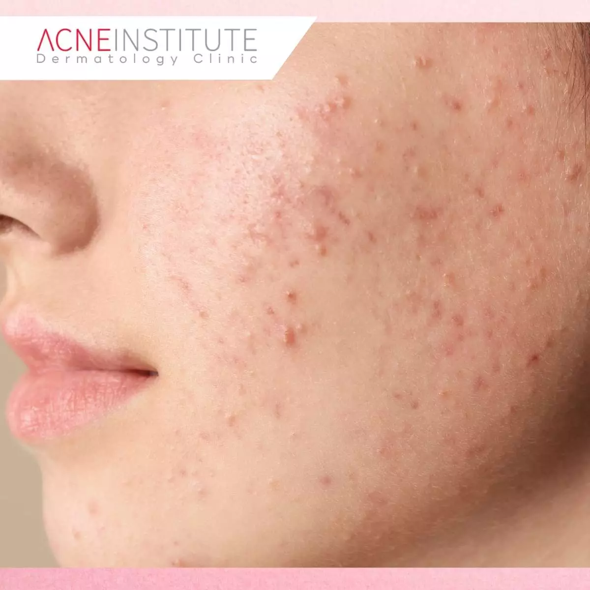 Ciri-Ciri Fungal Acne