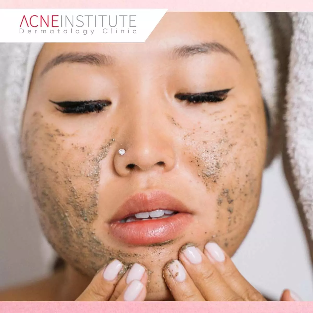 Mitos atau Fakta Seputar Fungal Acne