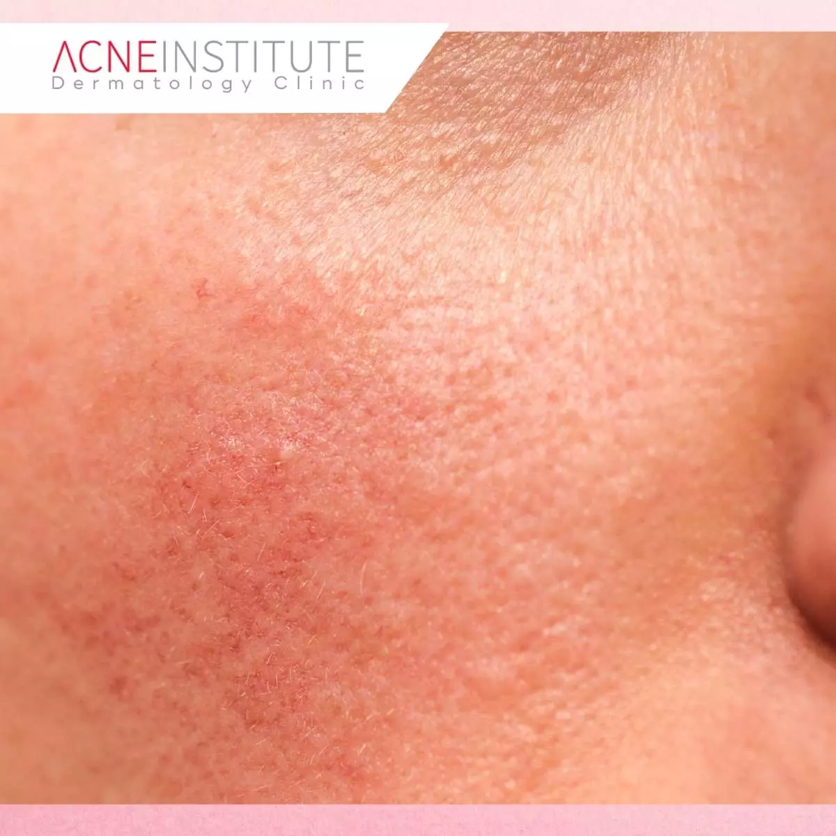 Meningkatkan Skin Barrier dengan Fiber Laser Treatment