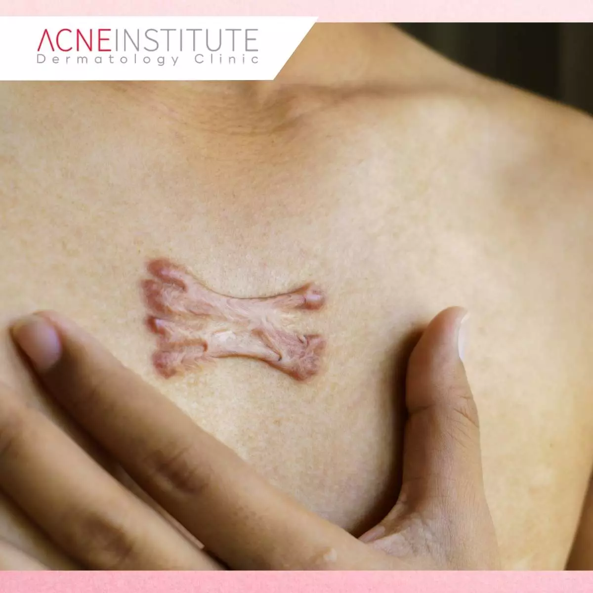 Prosedur Medis Suntik Keloid