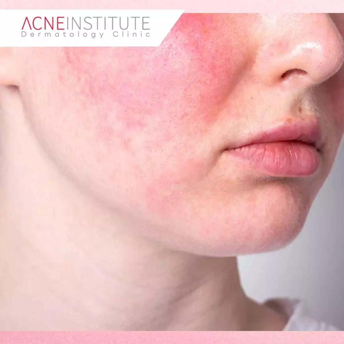 Downtime Treatment HIFU