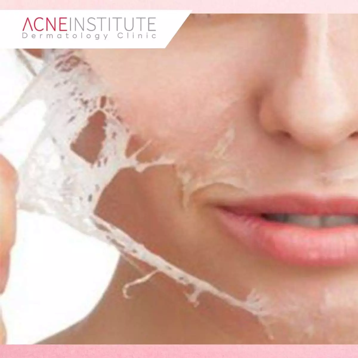 Prosedur Treatment Skin Booster di Acne Institute
