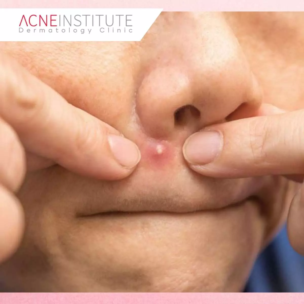 Tips Setelah Treatment Menggunakan Skin Booster