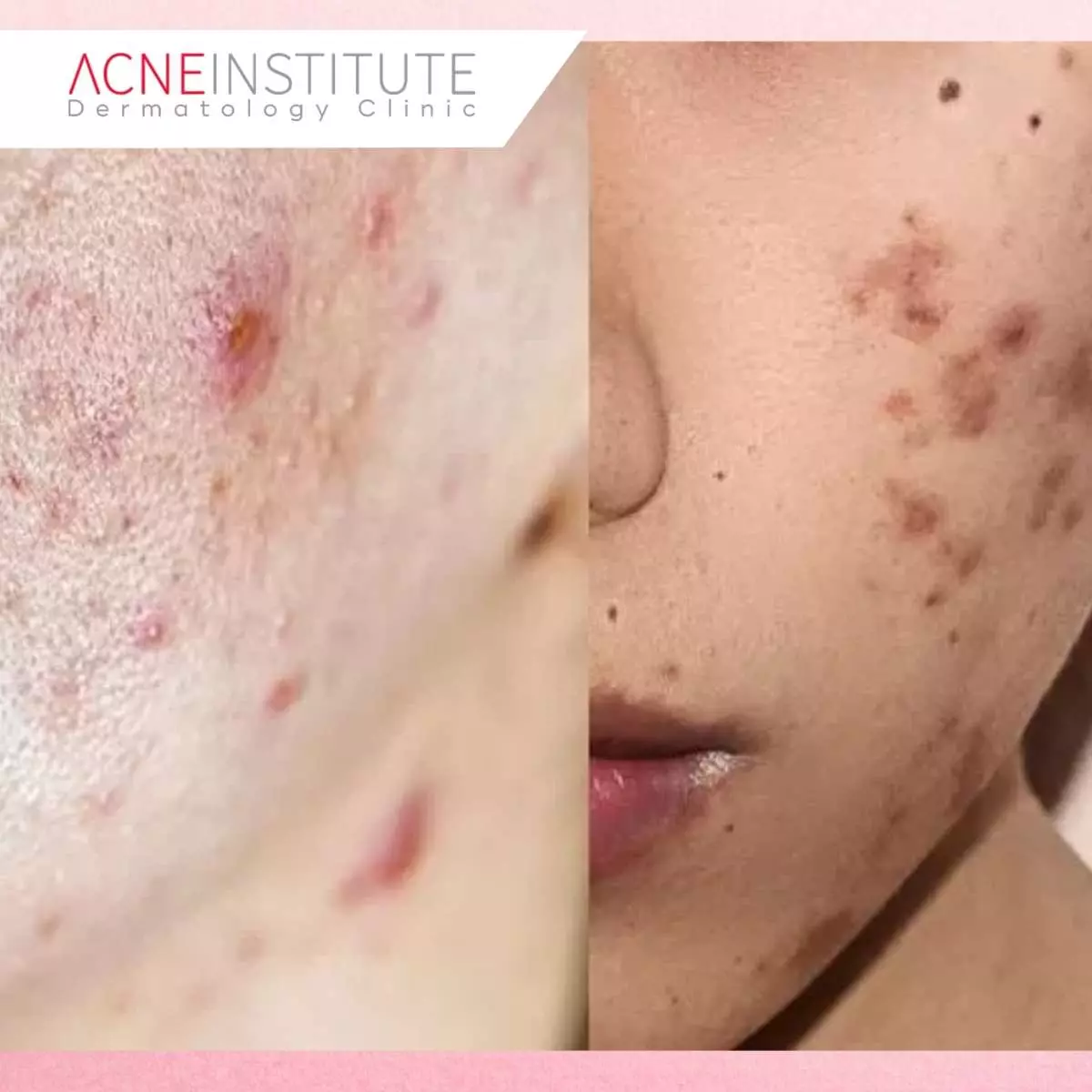 Basmi Bekas Jerawat Membandel Tanpa Ribet dengan Produk Skincare Acne Institute
