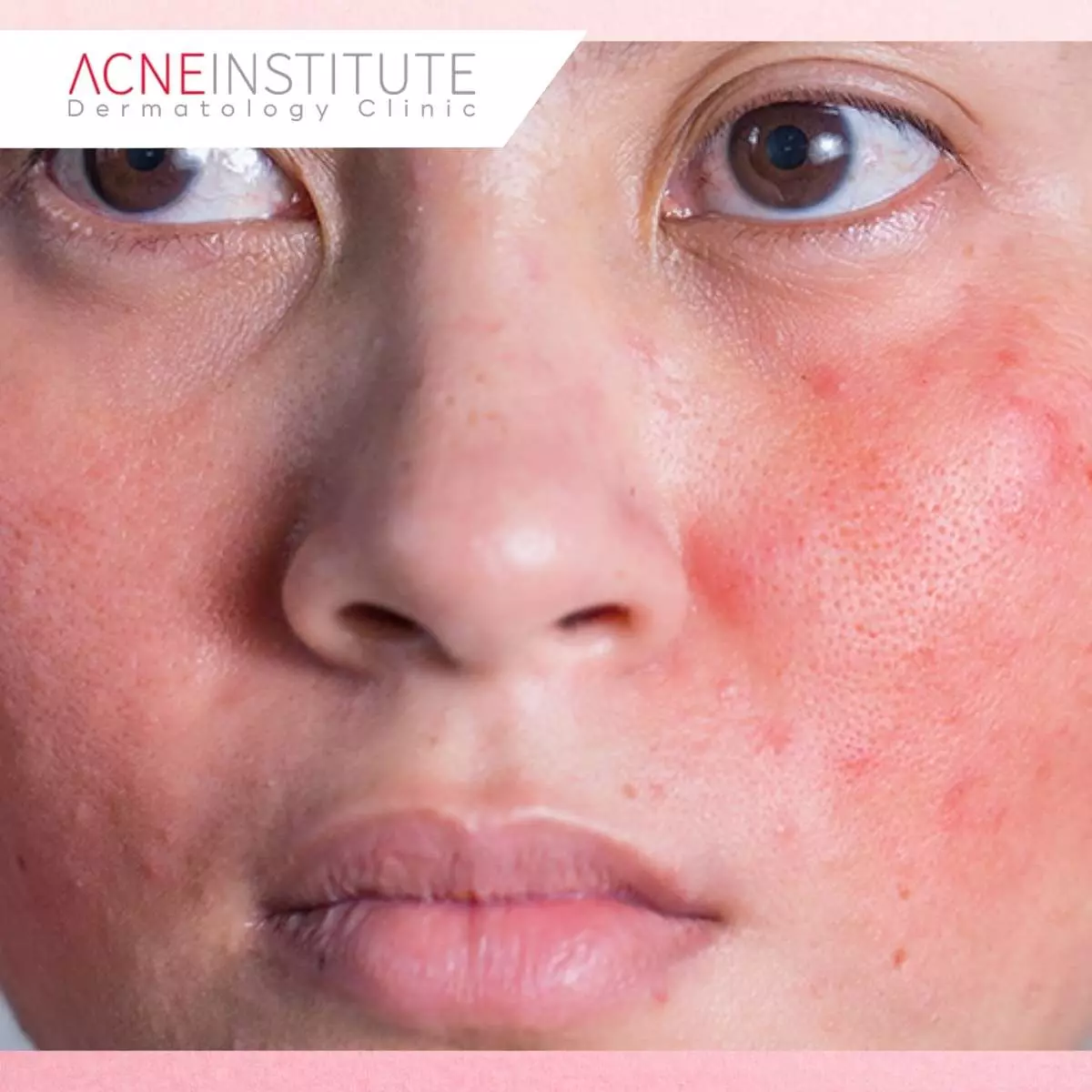 Kapan Harus Mencari Bantuan Medis atau Dermatolog?