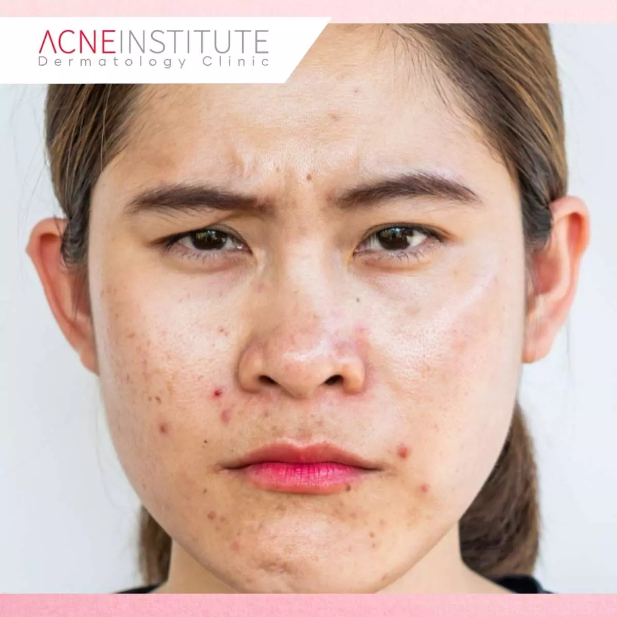 Kulit Cerah dan Bersih dengan Perawatan dari Acne Institute