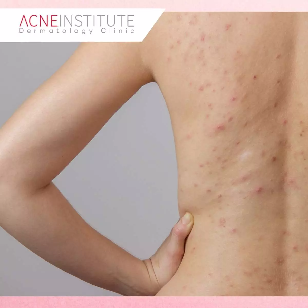 Perbedaan Body Acne dengan Jerawat Wajah