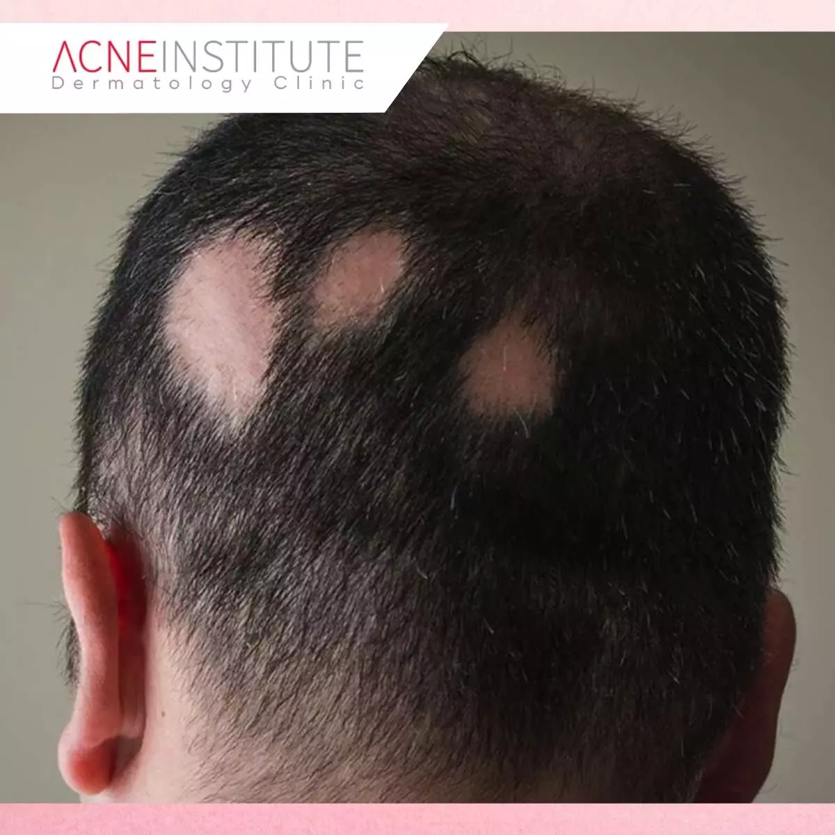 Rahasia Ampuh Atasi Kebotakan dengan Treatment Anti-Botak di Acne Institute