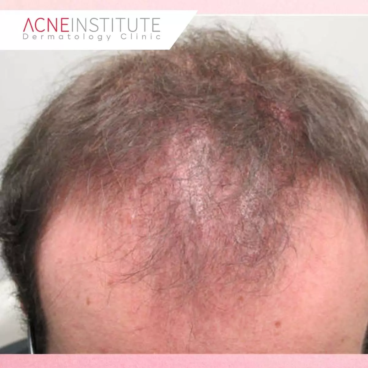 Proses Konsultasi dan Perawatan di Acne Institute