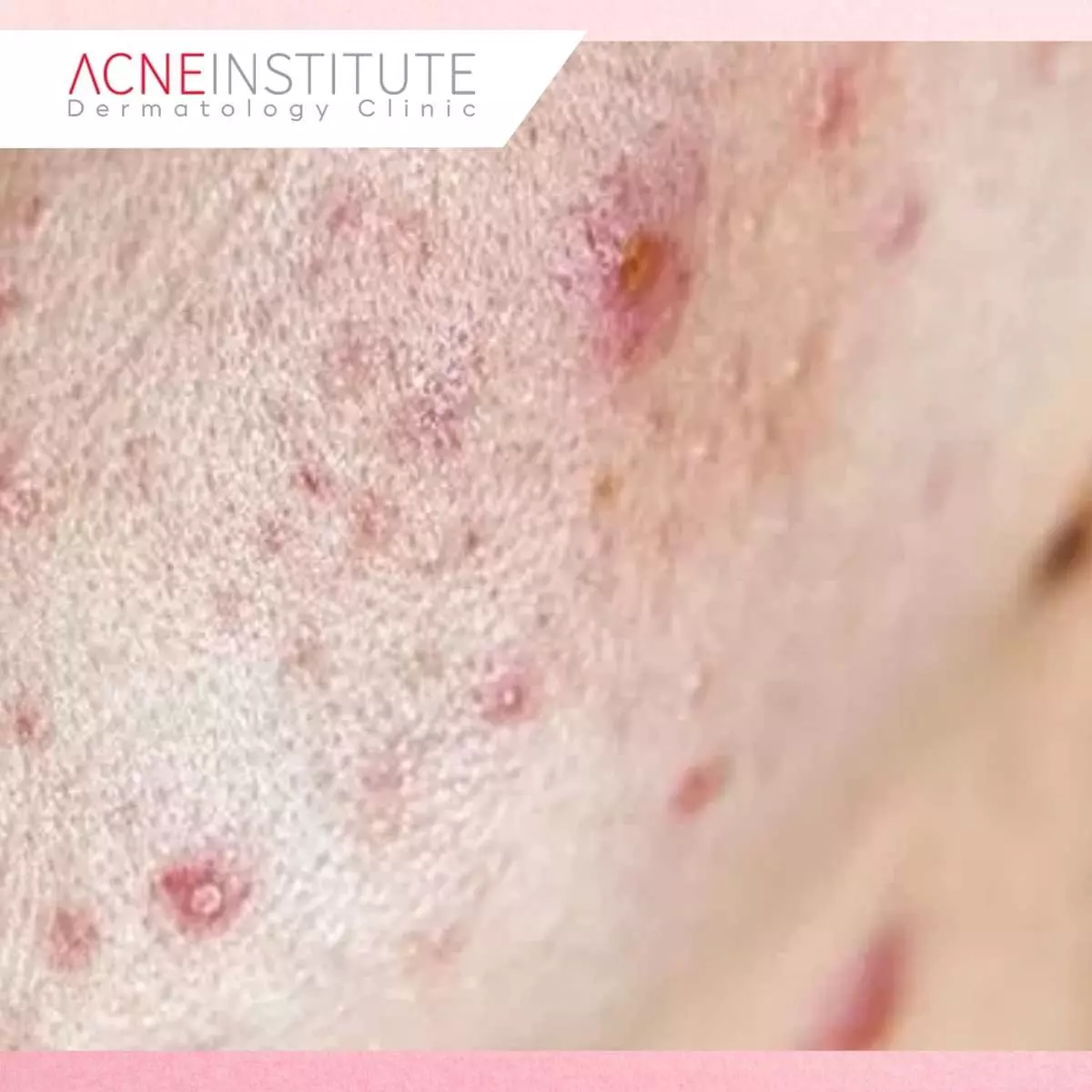 Rekomendasi Treatment di Acne Institute Berdasarkan Jenis Bekas Jerawat