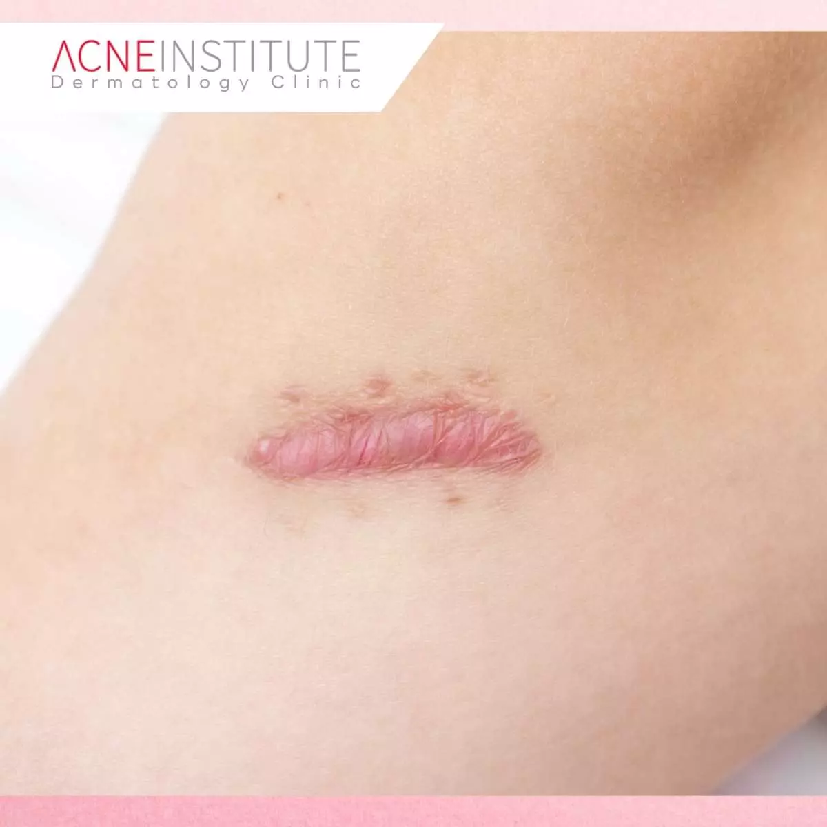Alasan Menghindari Operasi dalam Mengatasi Keloid