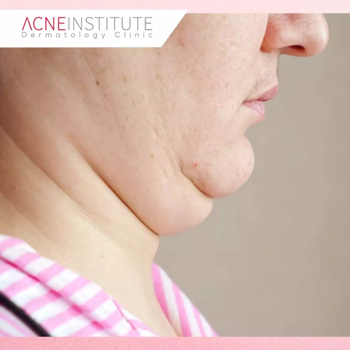 Penyebab Utama Munculnya Double Chin