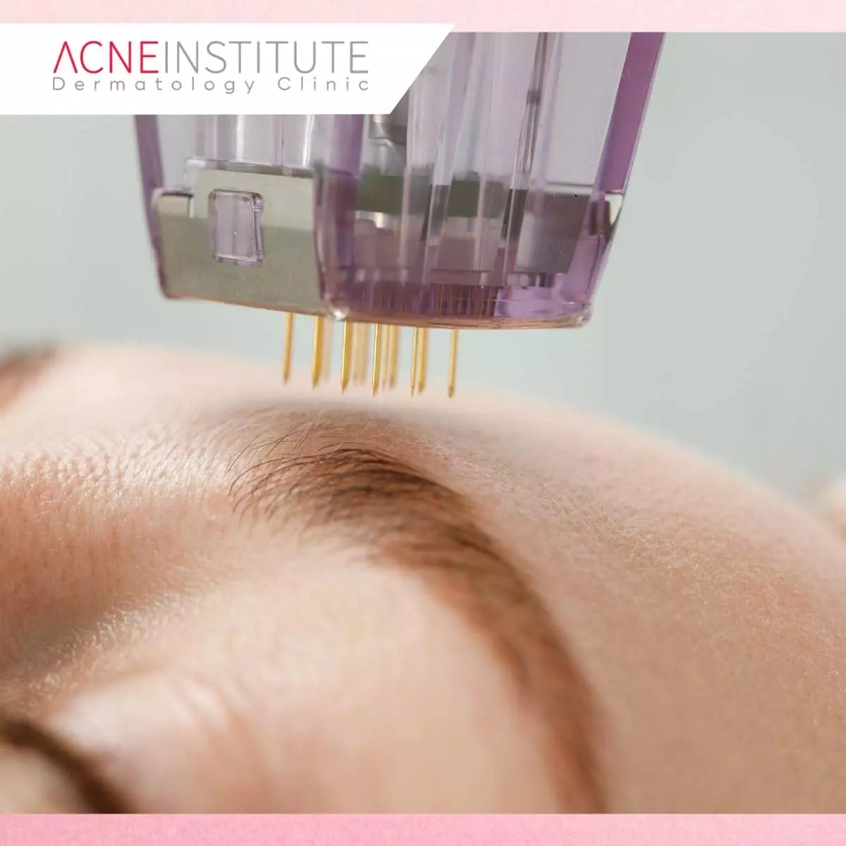 Manfaat Kedua Treatment Jerawat di Acne Institute Surabaya