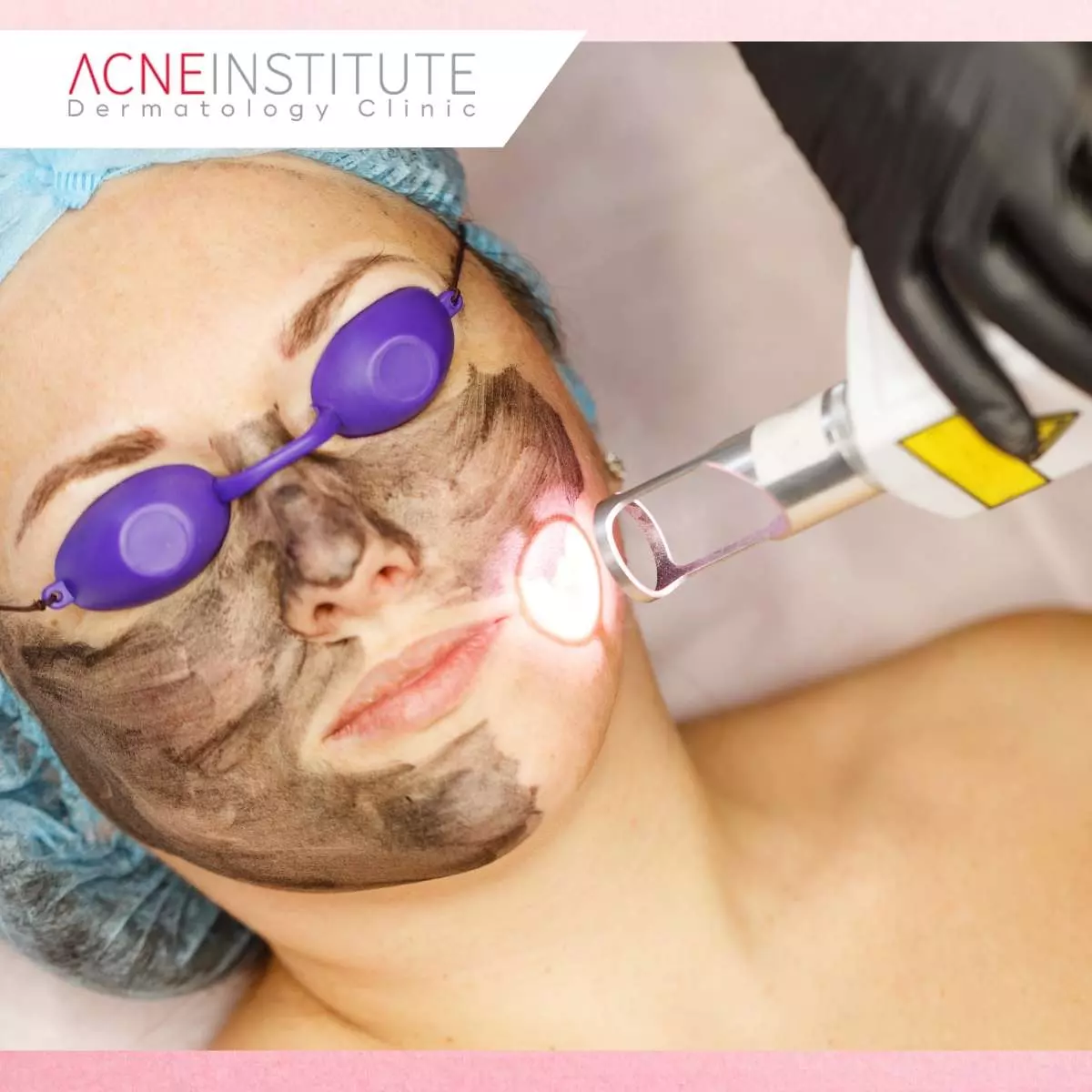 Keunggulan Perawatan Komedo di  Acne Institute Surabaya