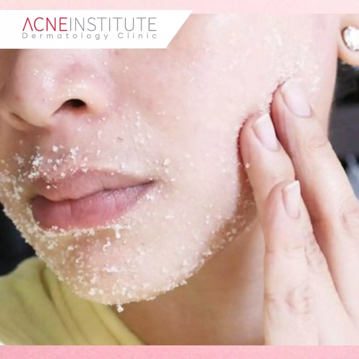 Tips Mencegah Komedo Kembali Setelah Treatment