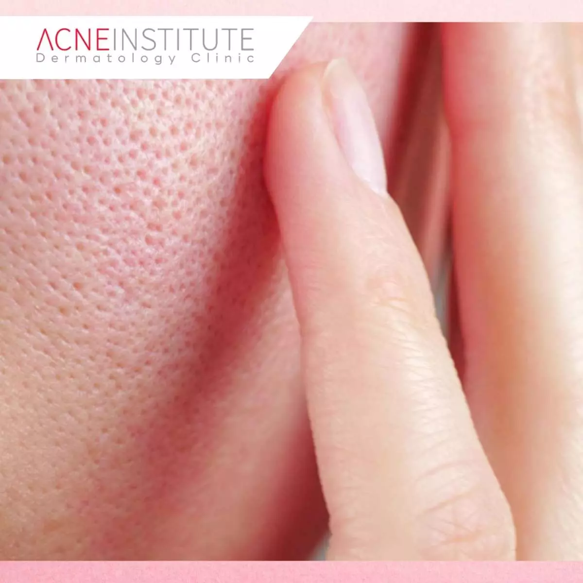 Sunscreen untuk Kulit Berjerawat Non-Comedogenic dan Anti Clog Pori