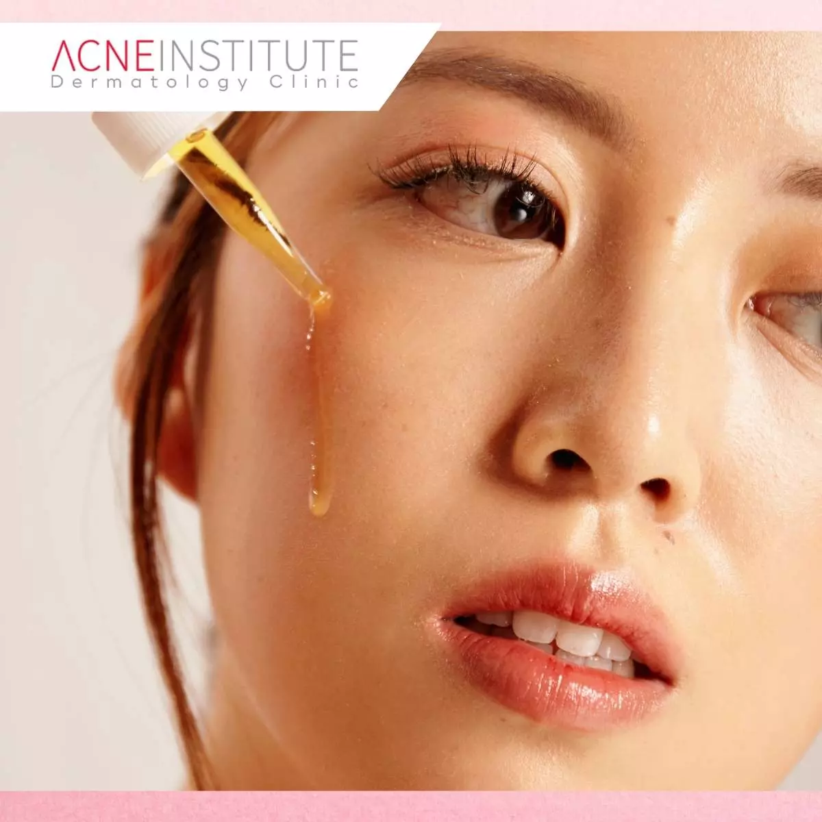 Tips Perawatan Pasca Prosedur Scar Correction Bekas Jerawat