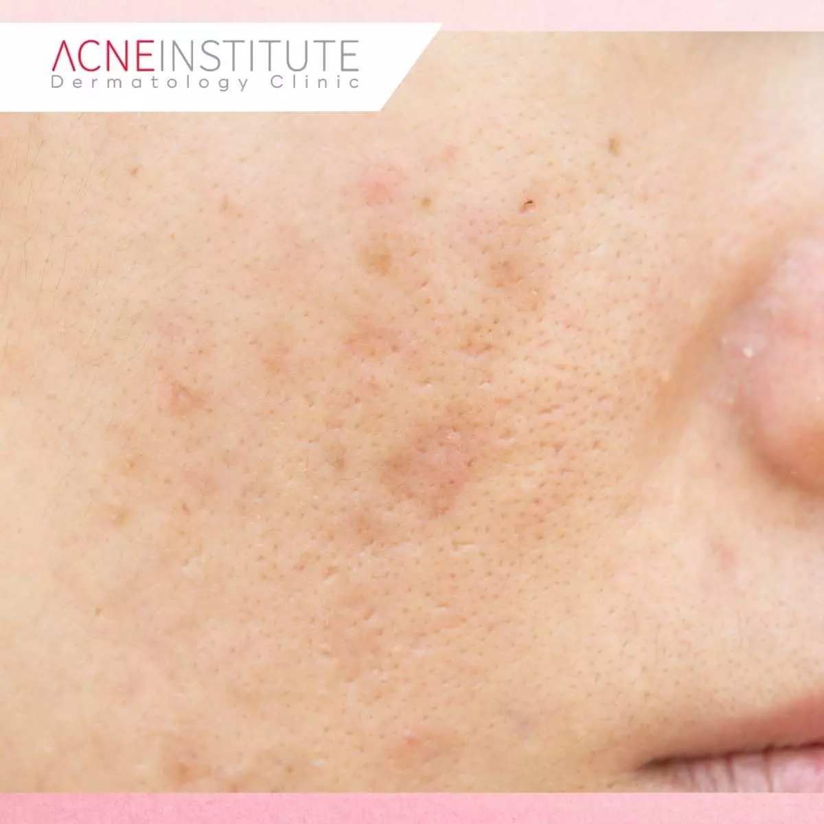 Perbedaan Dark Spot vs Sun Spot
