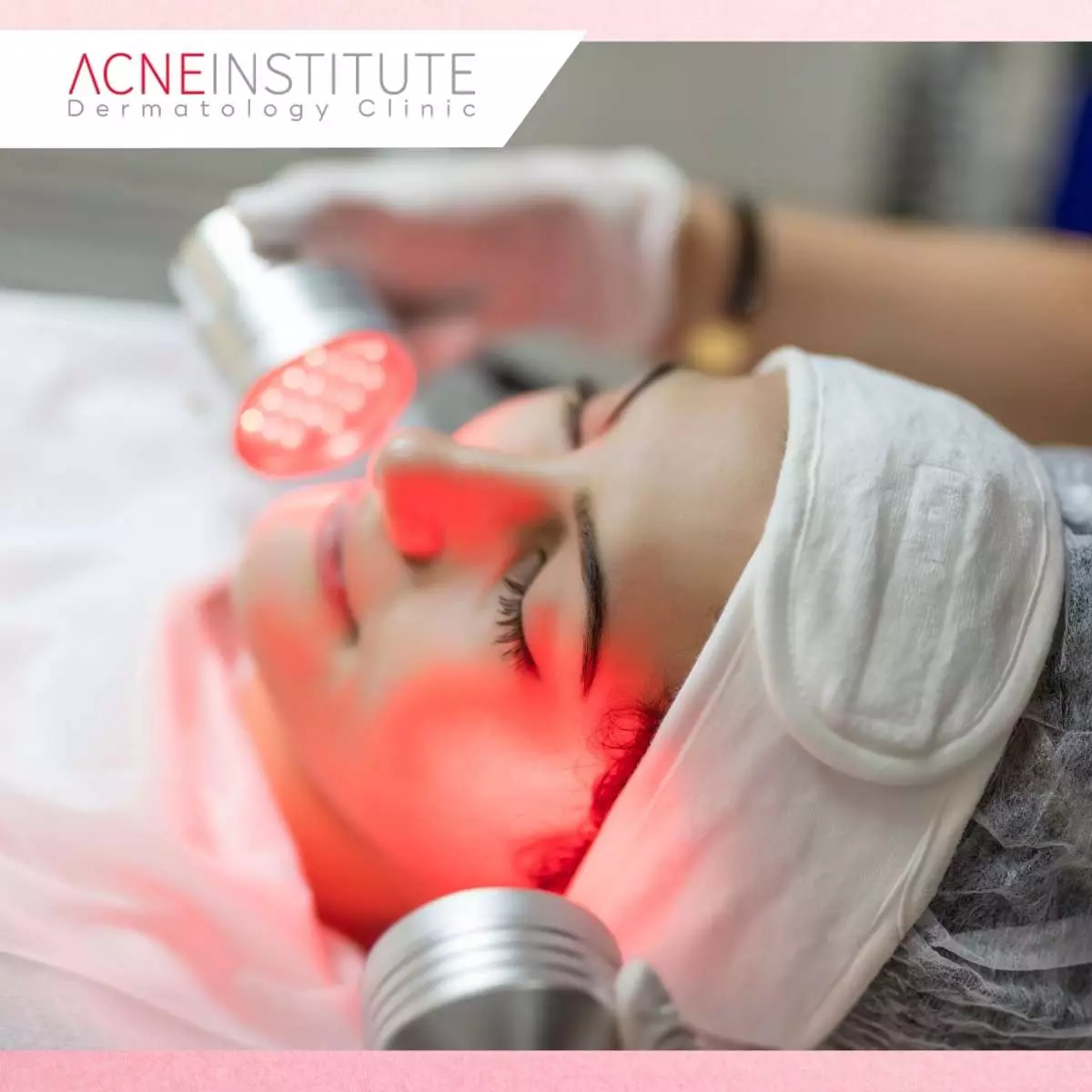 Laser Facial untuk Mengatasi Jerawat di Wajah dari DVX Medical Jakarta