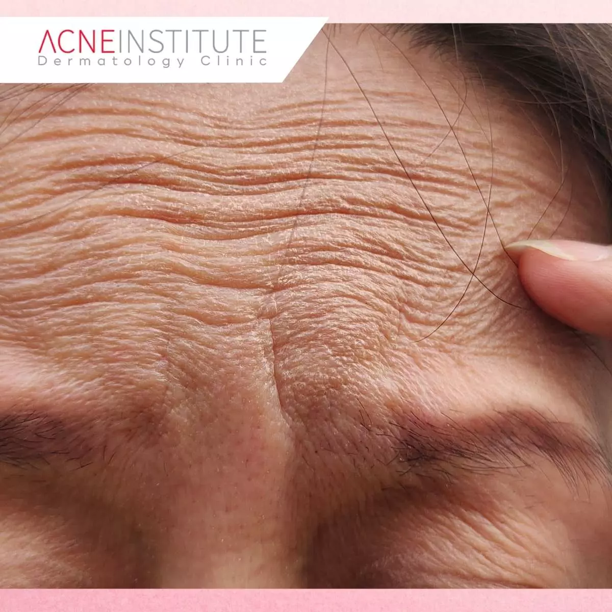 Perbedaan Bakuchiol dan Retinol: Mana yang Lebih Efektif?